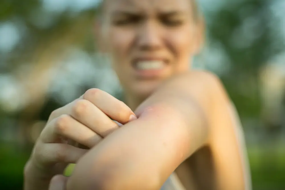 Con la canela, podrás decir adiós a esas picaduras de mosquitos tan molestas